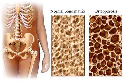 Csontritkulás tünetei és kezelése